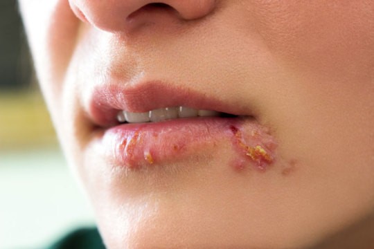 چگونه بطور طبیعی از علائم تبخال خلاص شویم