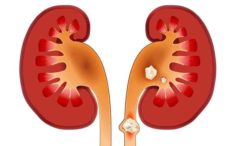 سنگ کلیه و بهترین روش های پیشگیری از آن