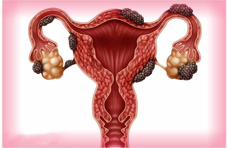در صورت آندومتریوز از چه چیزهایی باید خودداری کنم؟