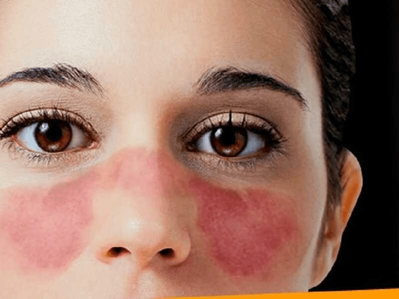 لوپوس چگونه تشخیص داده می شود؟