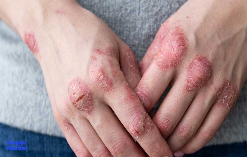 پسوریازیس چیست و چه افرادی به آن مبتلا می شوند؟