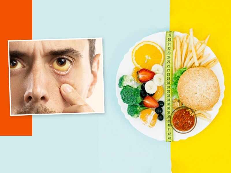 رژیم غذایی زردی: راهنمای جامع برای خوردن و یا اجتناب