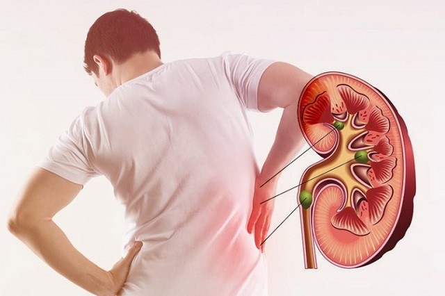 علائم و نشانه های سنگ کلیه!