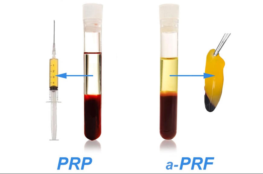 PRF چیست و چه تفاوتی با PRP دارد؟