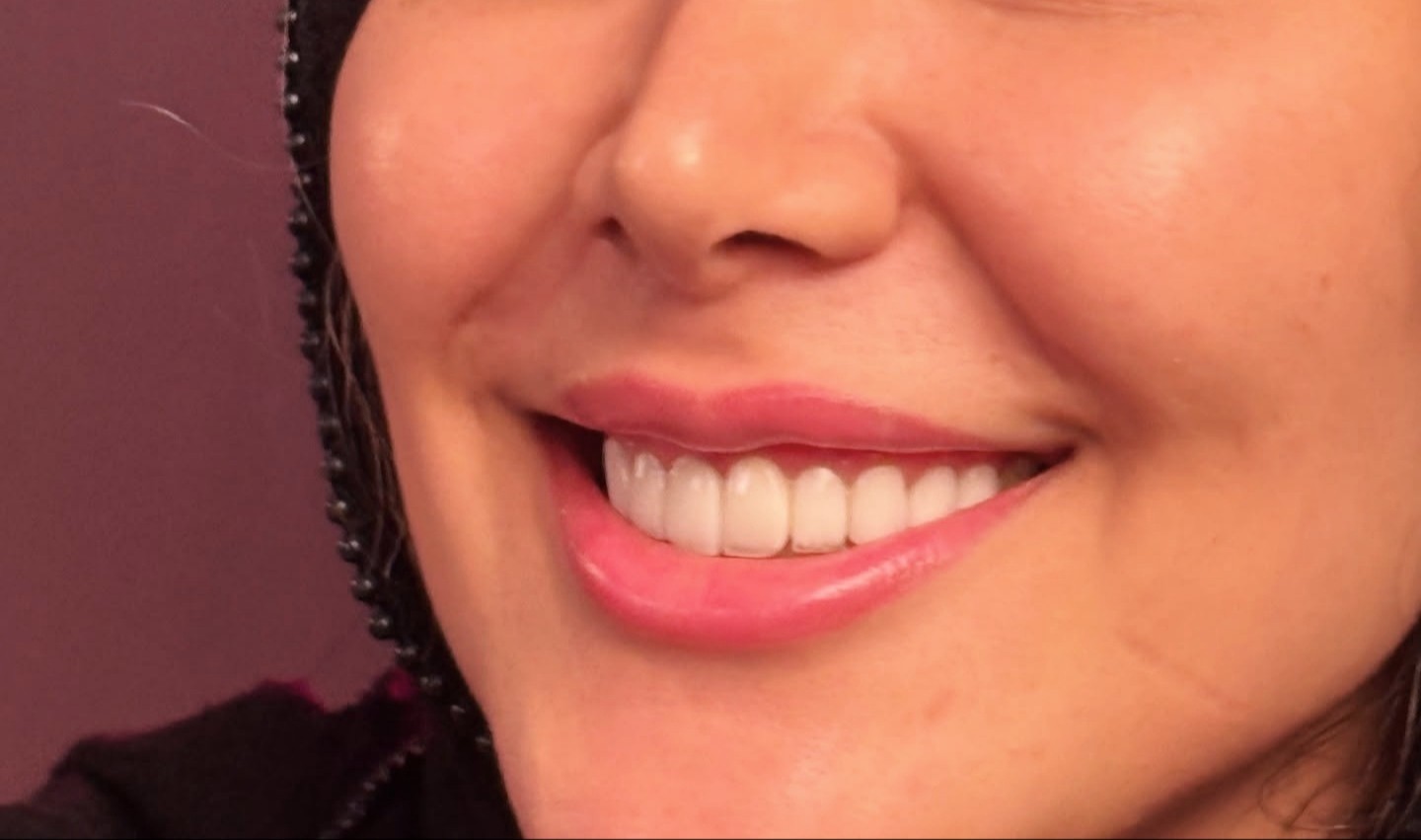 لمینت های سرامیکی دندان e-max لبه شیشه ای
