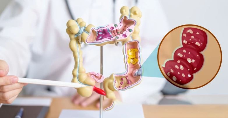 آیا عدم تحمل گلوتن می‌تواند باعث مشکلات سیستم ایمنی شود؟