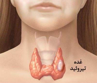 علائم کم کاری تیروئید 