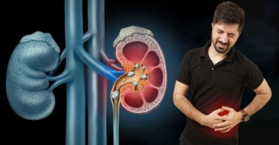 علائم و نشانه های سنگ کلیه!